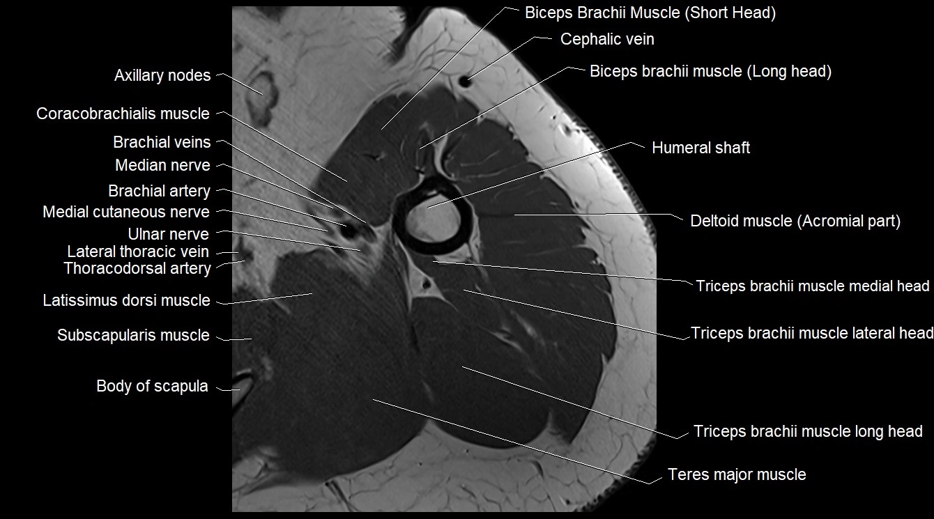 Upper arm( humerus) cross section anatomy MRI 3T axial image 22.webp